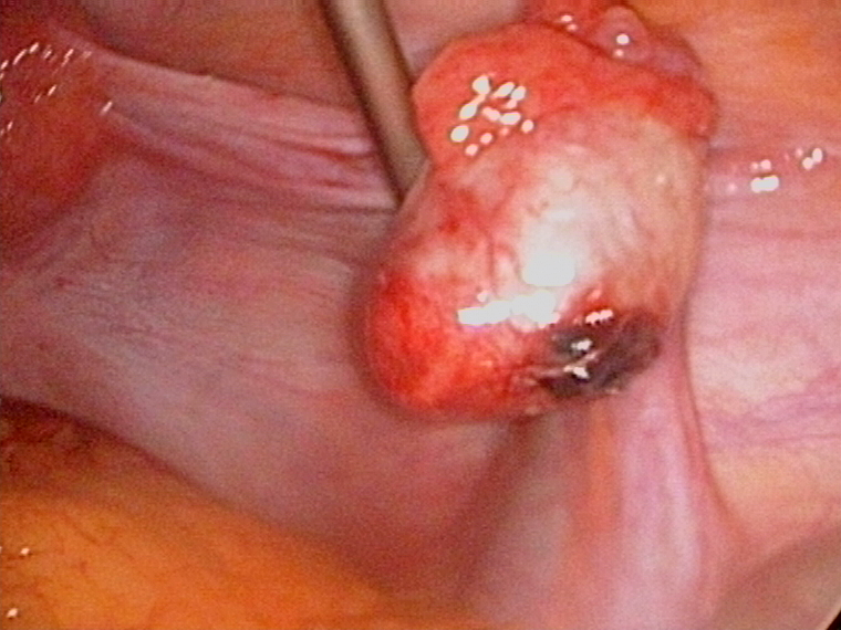 corpus luteum haemorrhage point of rupture